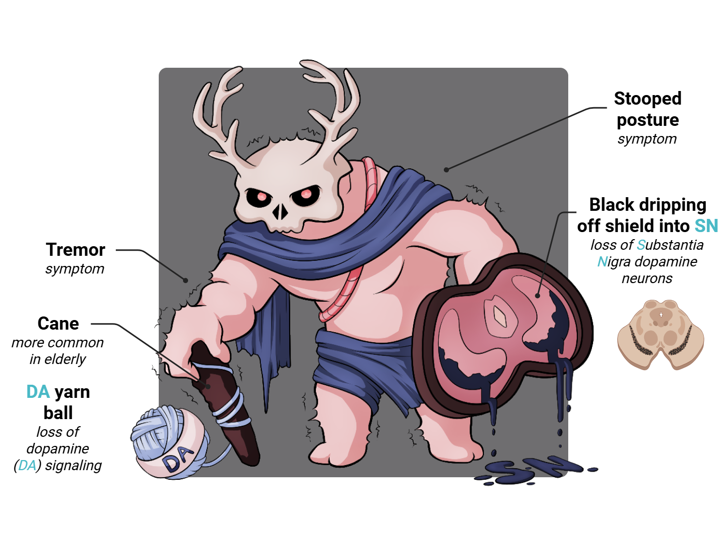 Parkinson Disease Medimon infographic with labeled medical features and mnemonic annotations.