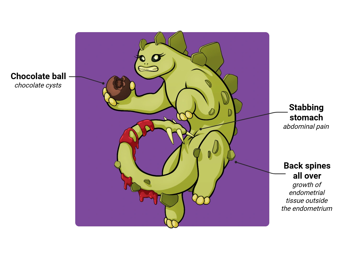 Endometriosis Medimon infographic with labeled medical features and mnemonic annotations.