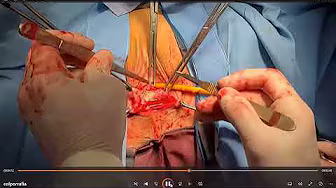 Video sobre colporrafia anterior y posterior