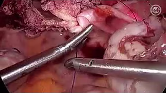 Video sobre Ureteres