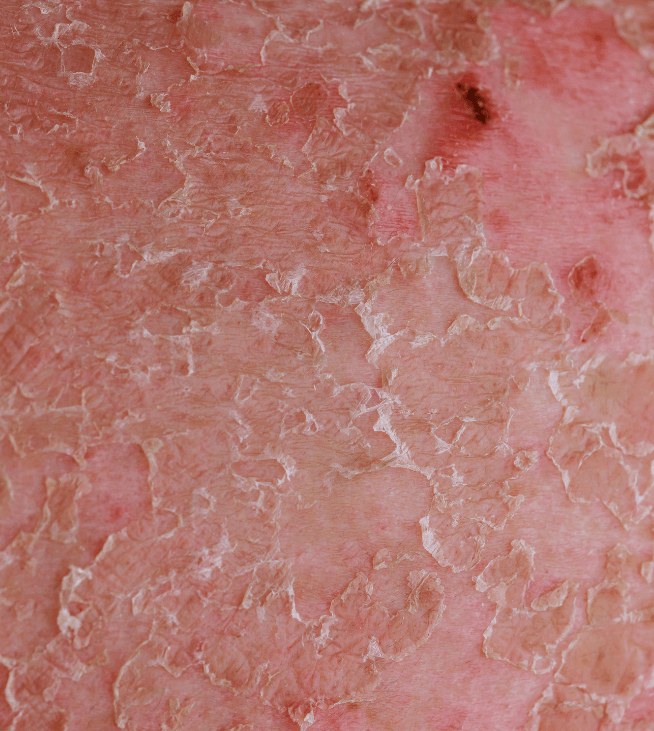 Dry and flakey skin