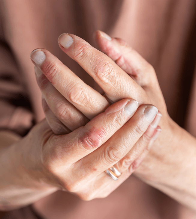 close-up image of a hand with eczema