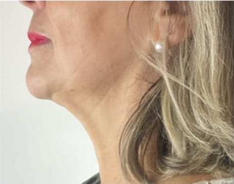 6 mois apr&egrave;s