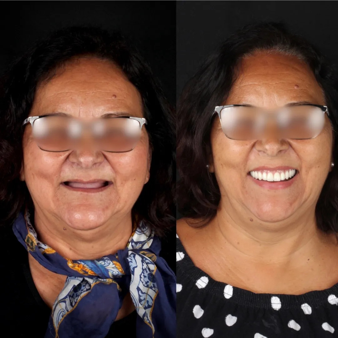 Prótese Protocolo em Goiânia - Resultado paciente mulher