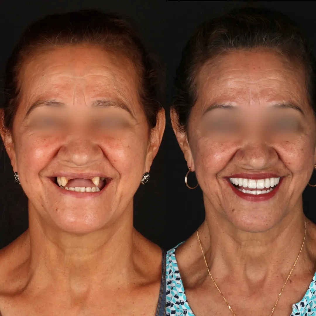 Implante dentário em Goiânia - Resultado paciente mulher