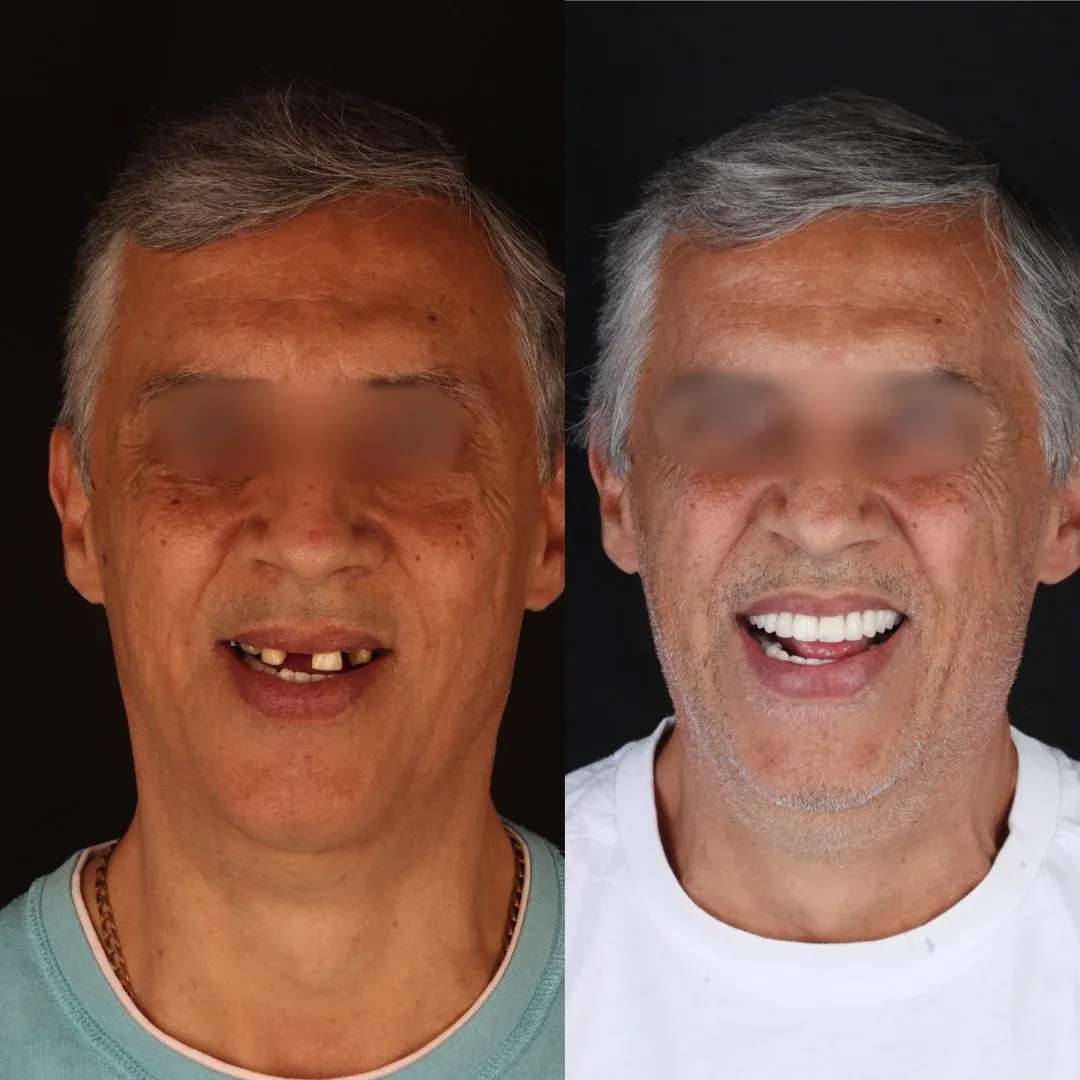 Implante dentário em Goiânia - Resultado paciente homem