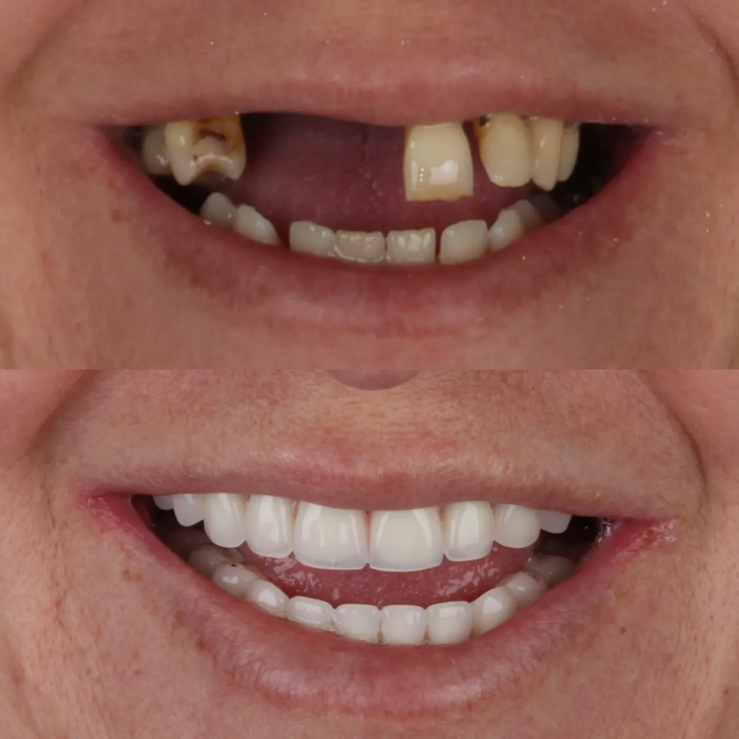 Facetas em Resina em Goiânia - Resultado paciente mulher