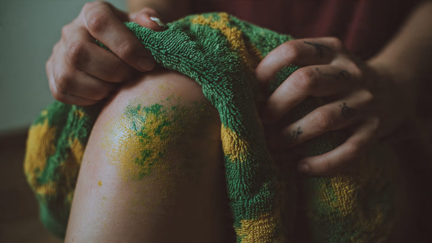 Using a warm compress to speed up bruise healing after the initial swelling.