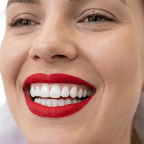 sorriso perfetto e bianco dopo trattamento studio dentistico de biase spinaceto