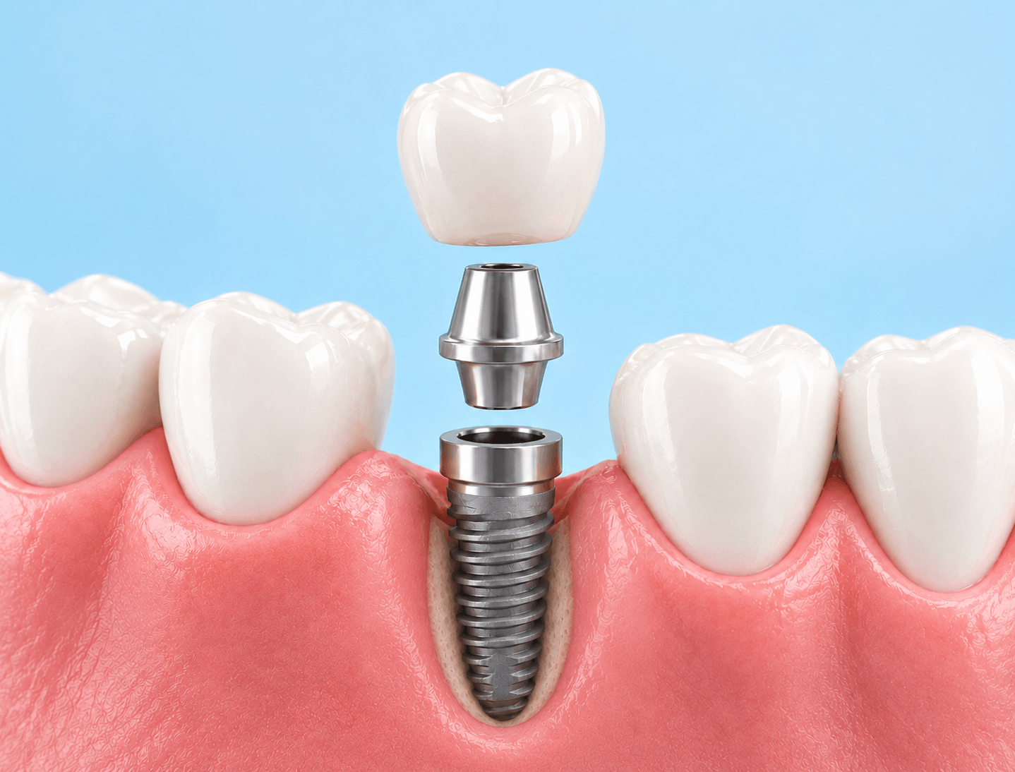Implante y corona dental