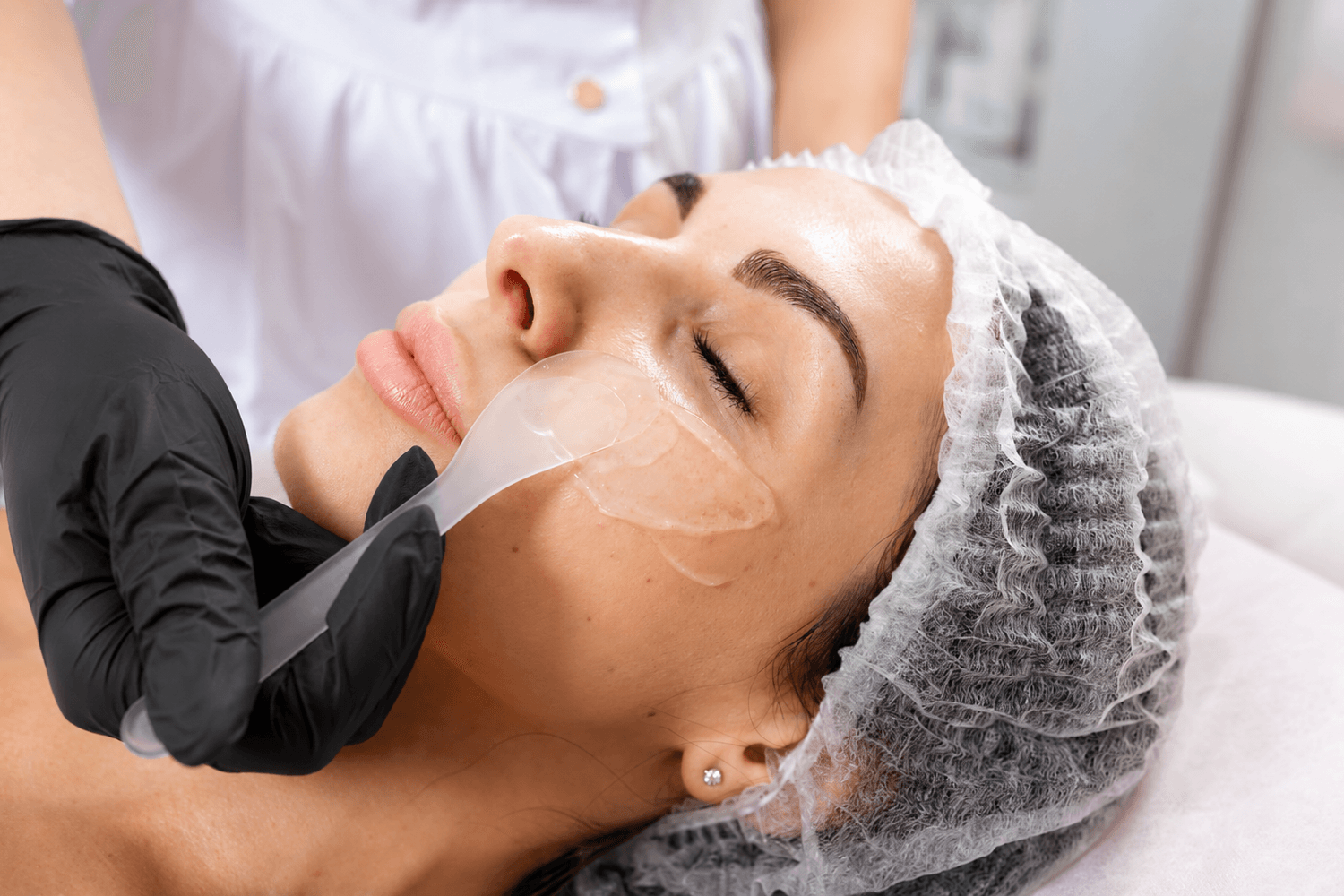 Peeling superficiel