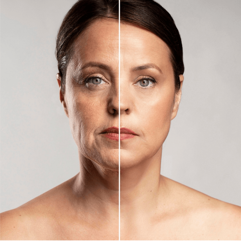HIFU Facial