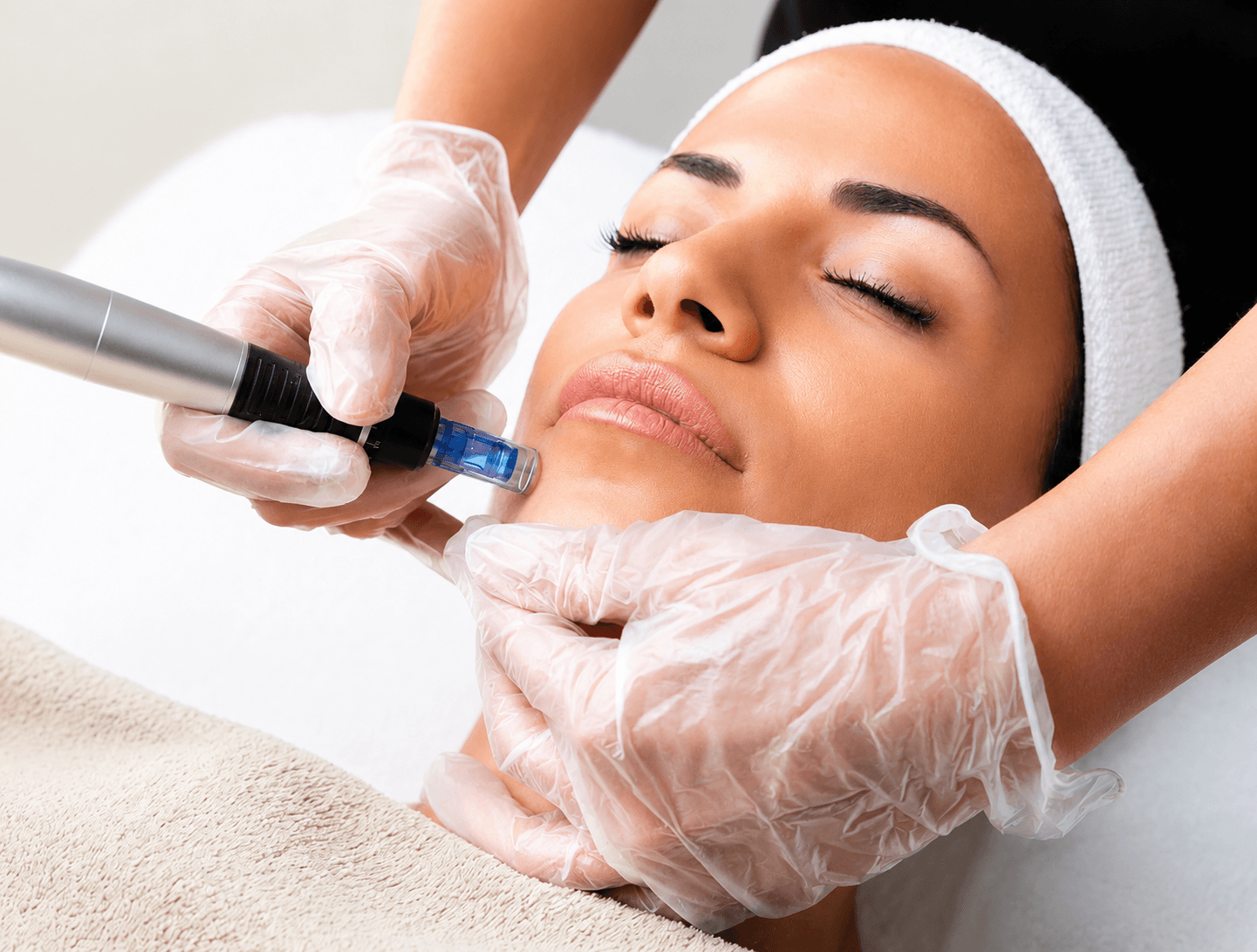 Microneedling