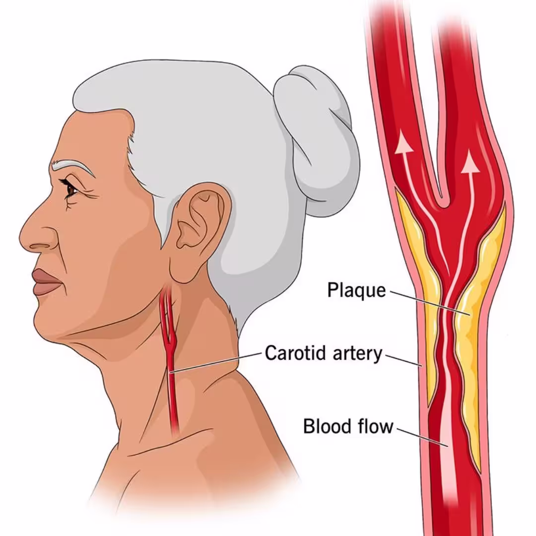 Artery: plaque building up and blood flow