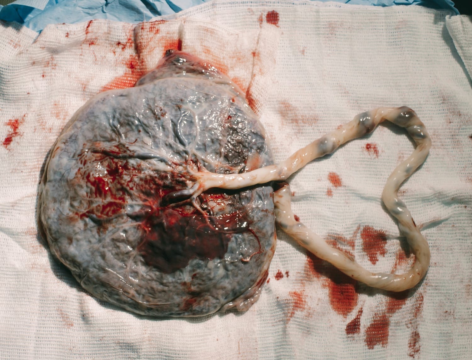 Le placenta, un magnifique organe à forme d'arbre de vie