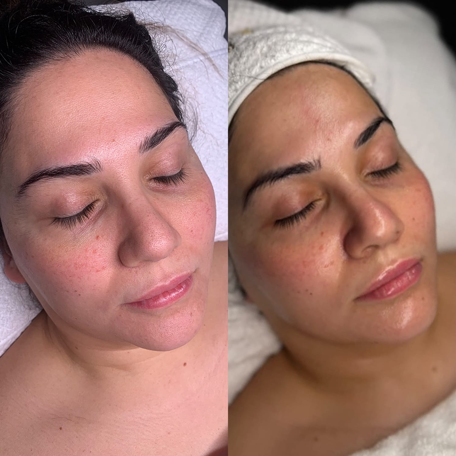 Avant après Hydraface