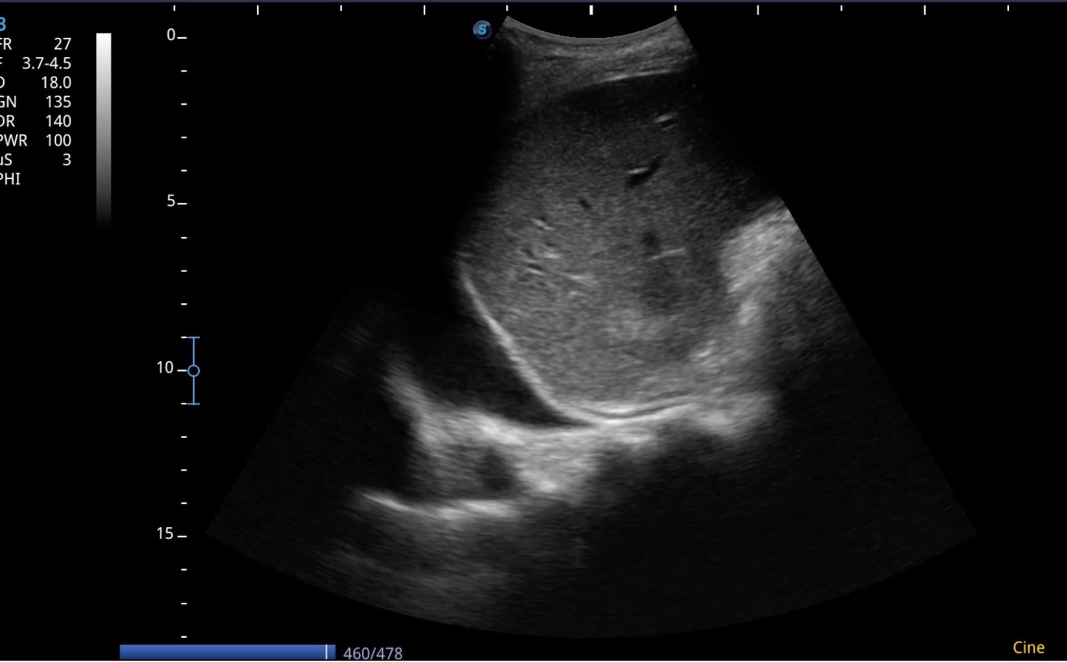 Epanchement pleural en échographie