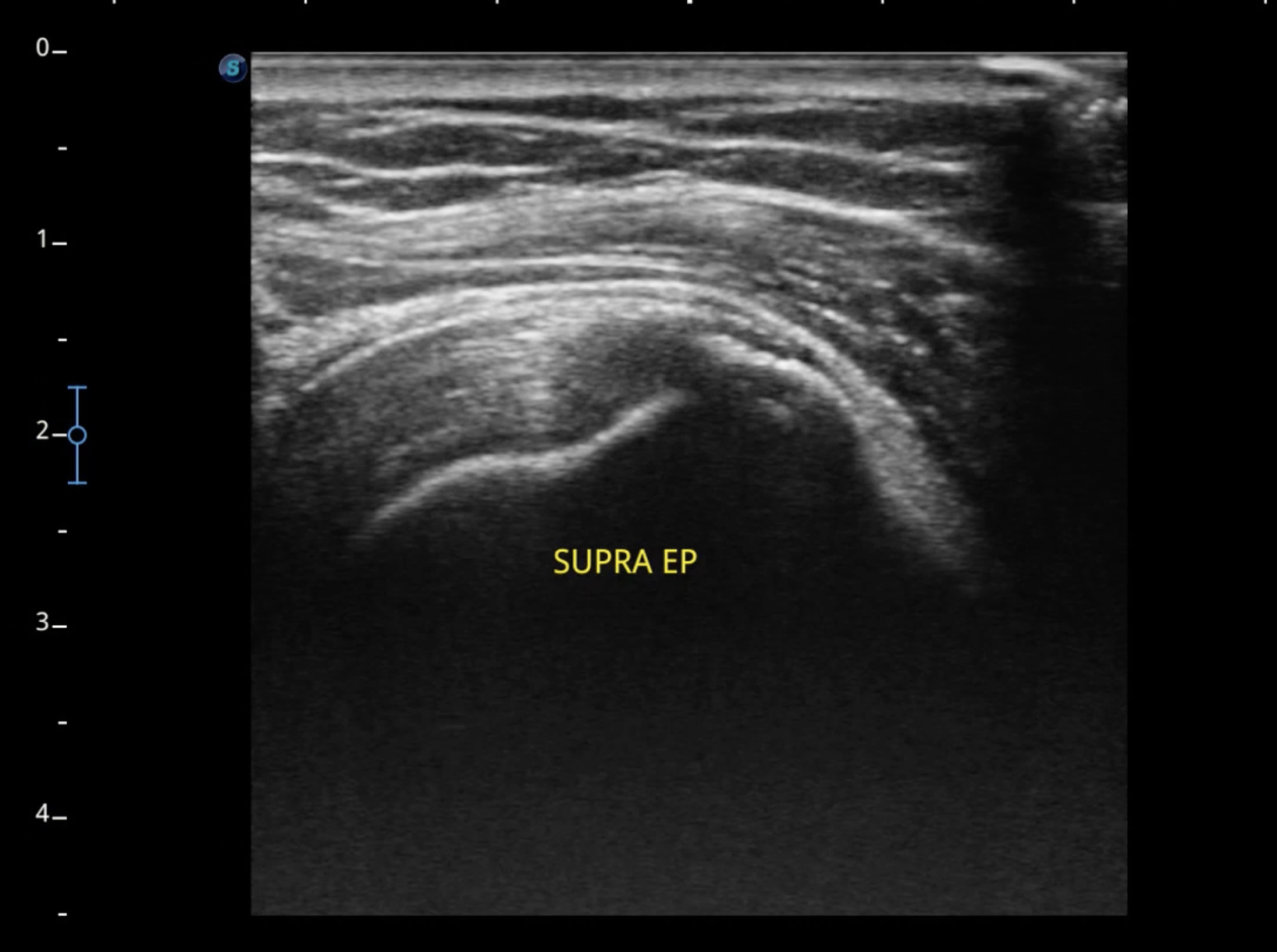 Bursite deltoidienne en échographie