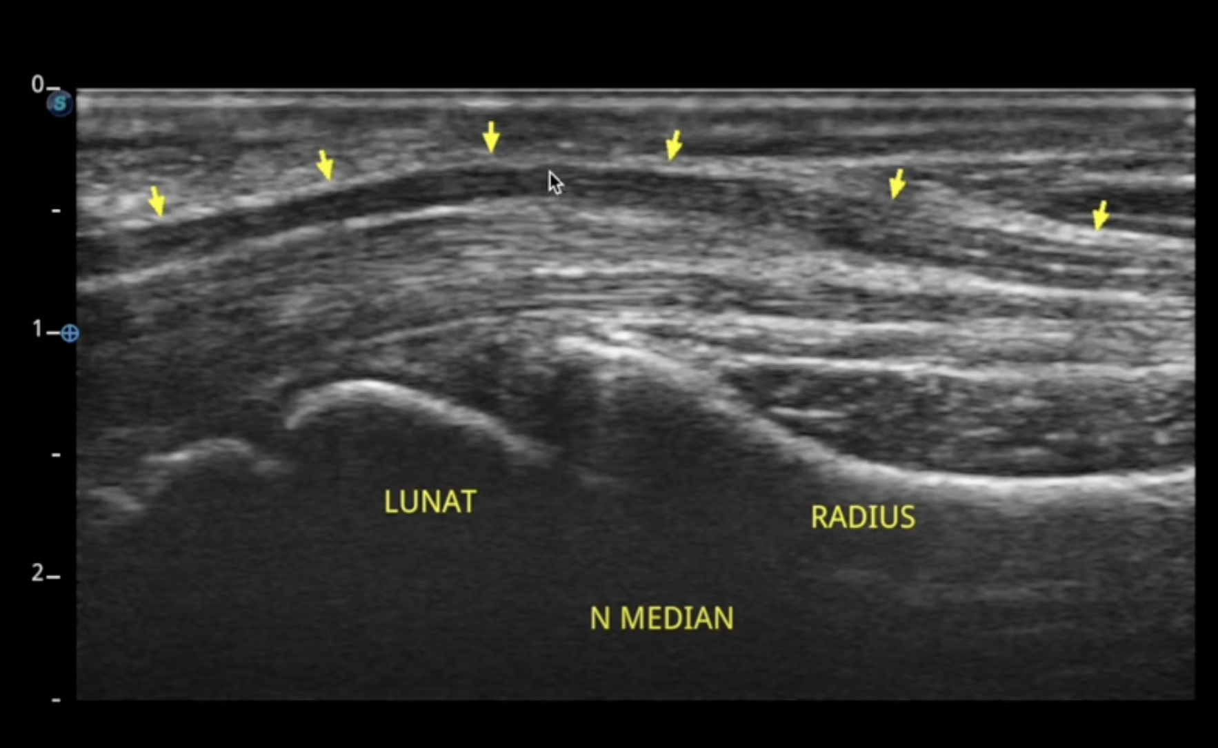 Repérer facilement le nerf médian en échographie au niveau du canal carpien