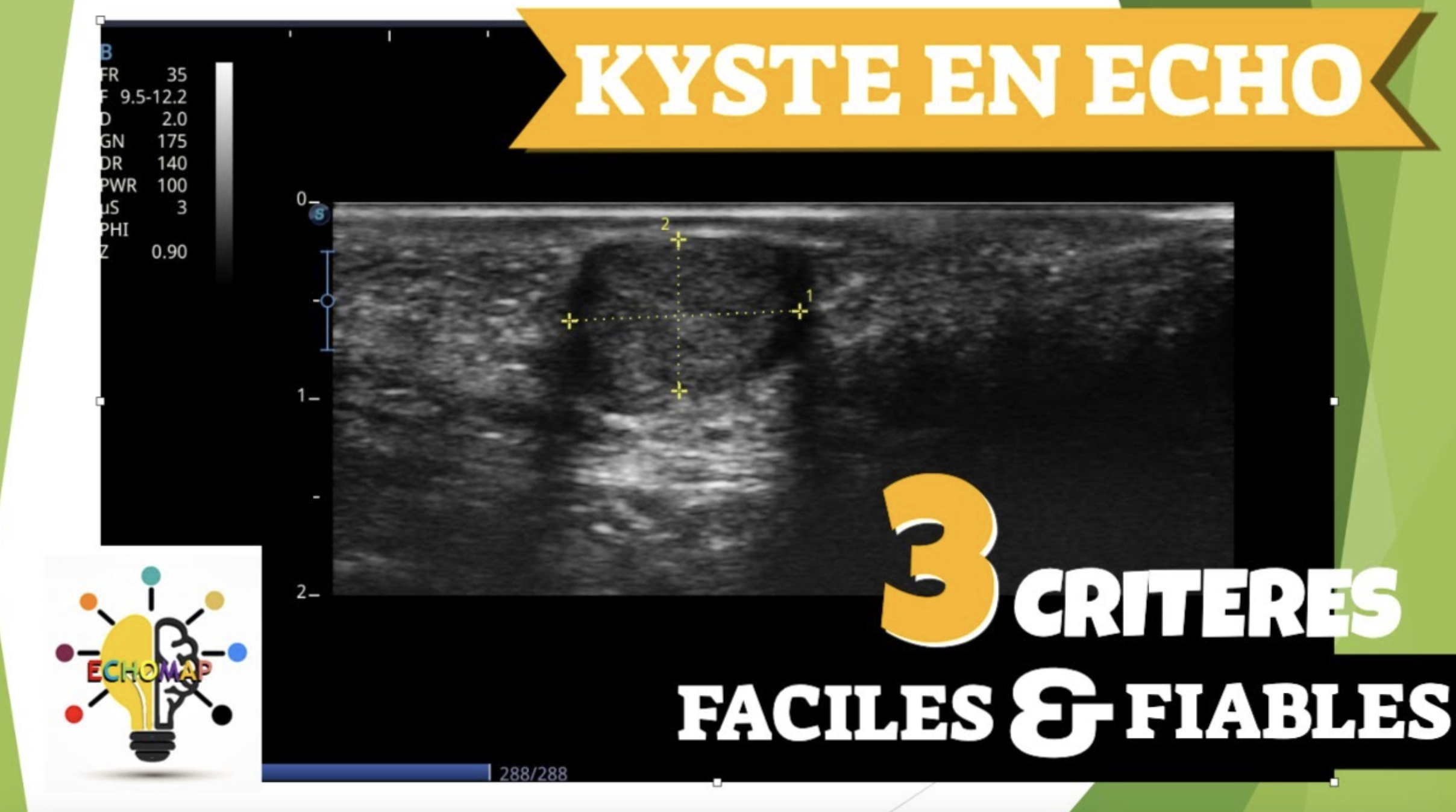 Diagnostiquer un kyste en échographie