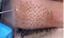 Obtenez la formation Plasma Lift dès maintenant !