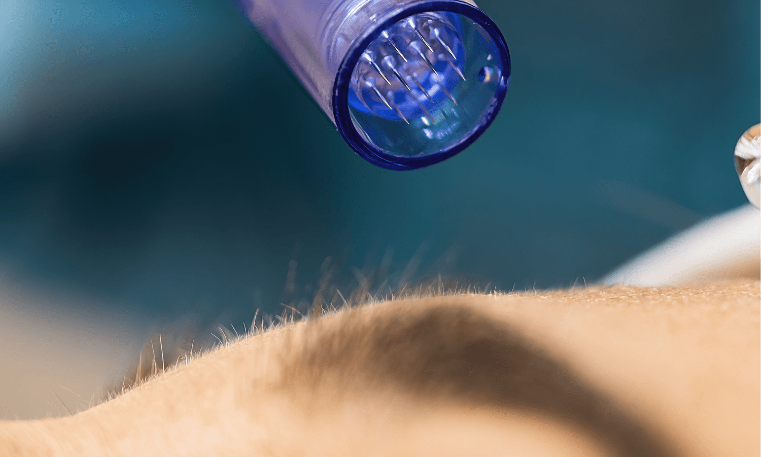 Formation Microneedling