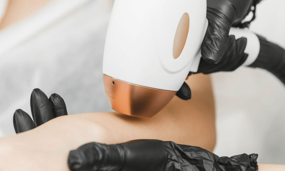 Formation epilation définitive
