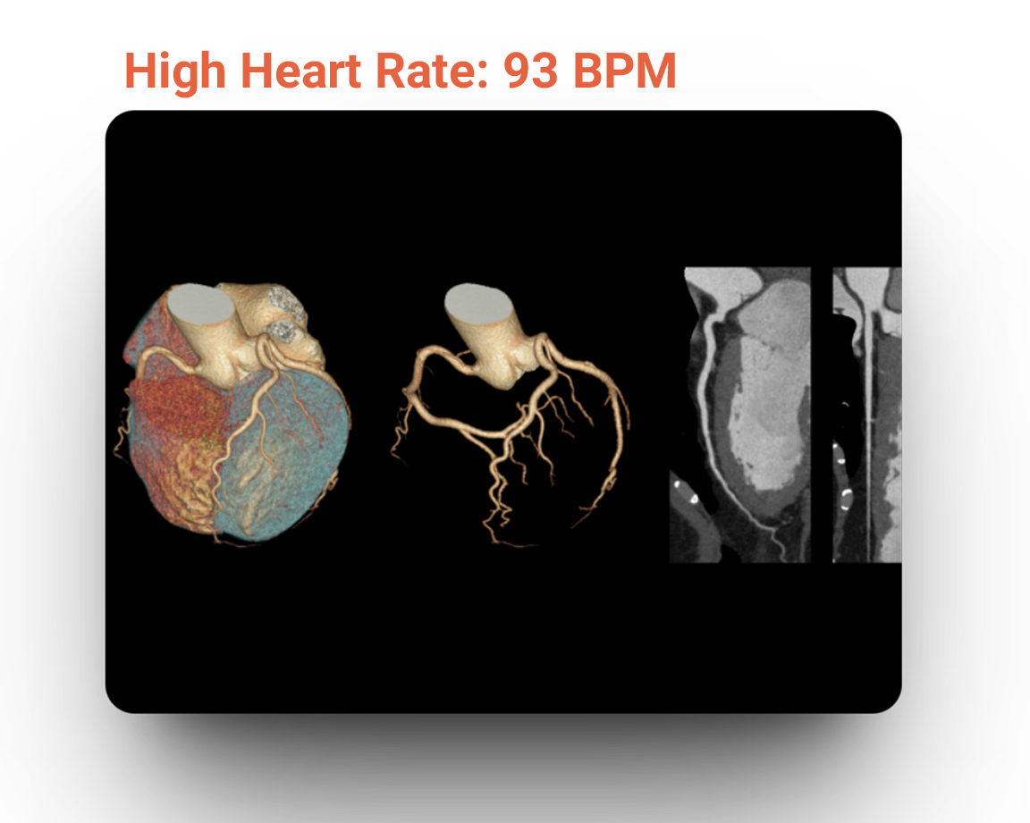 High Heart Rate