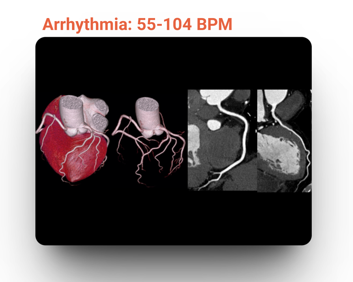Arrhythmia: 55-104 bpm