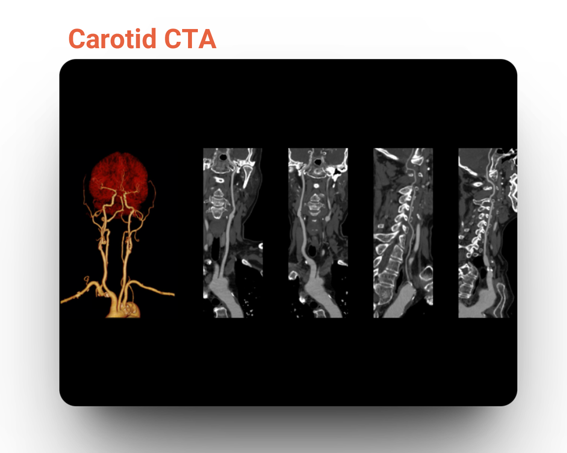 Carotid CTA