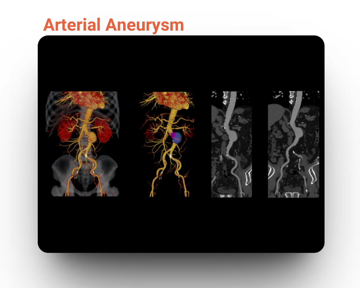 Arterial Aneurysm