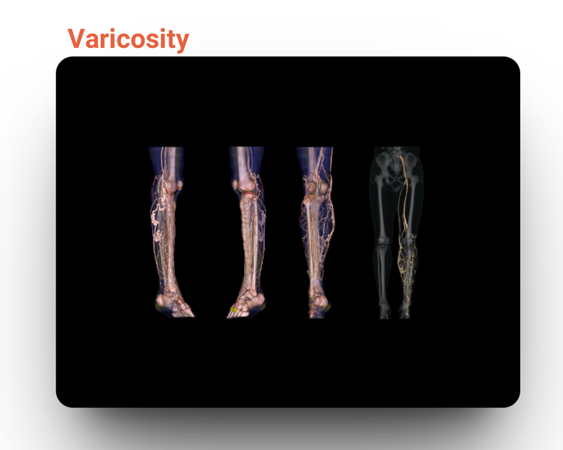 Varicosity