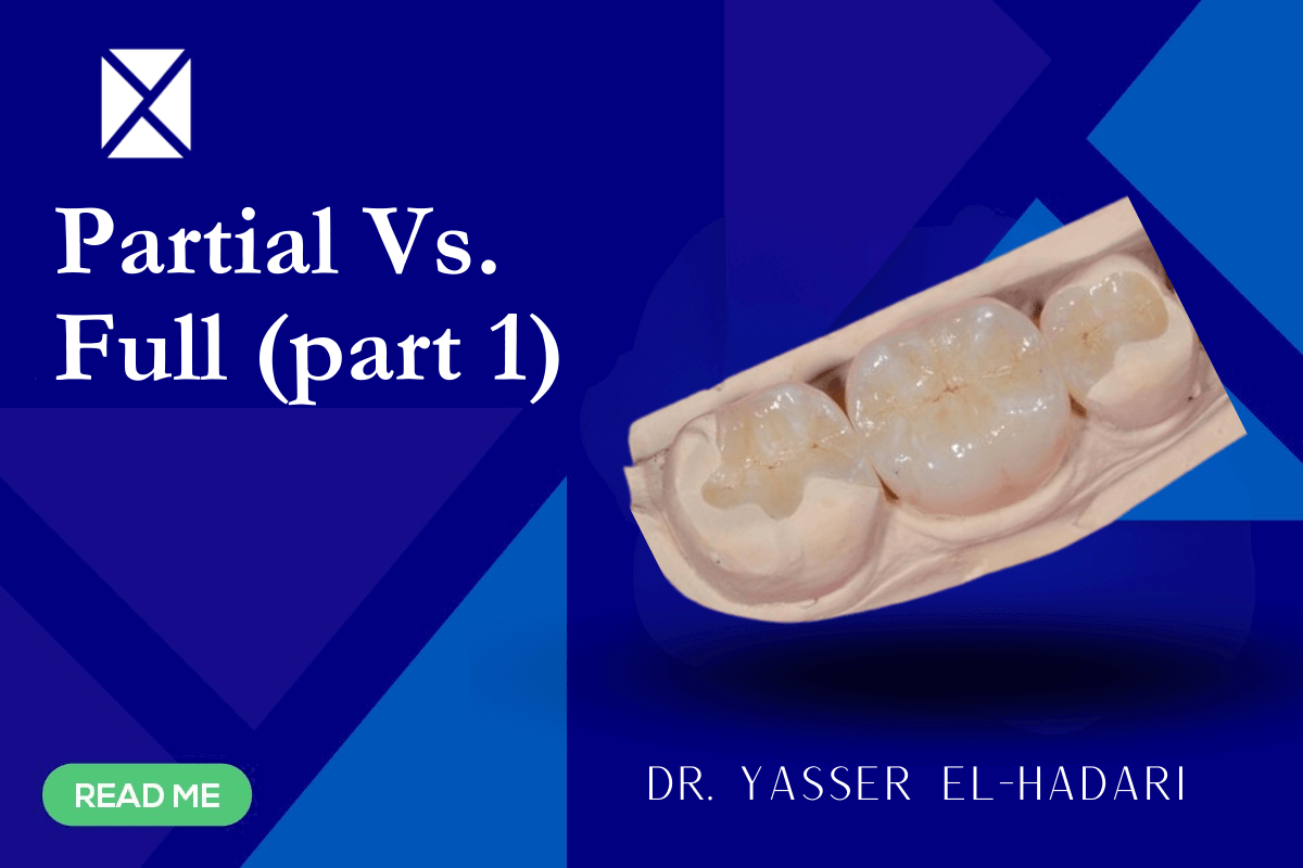 Partial vs Full Coverage Restorations Part 1