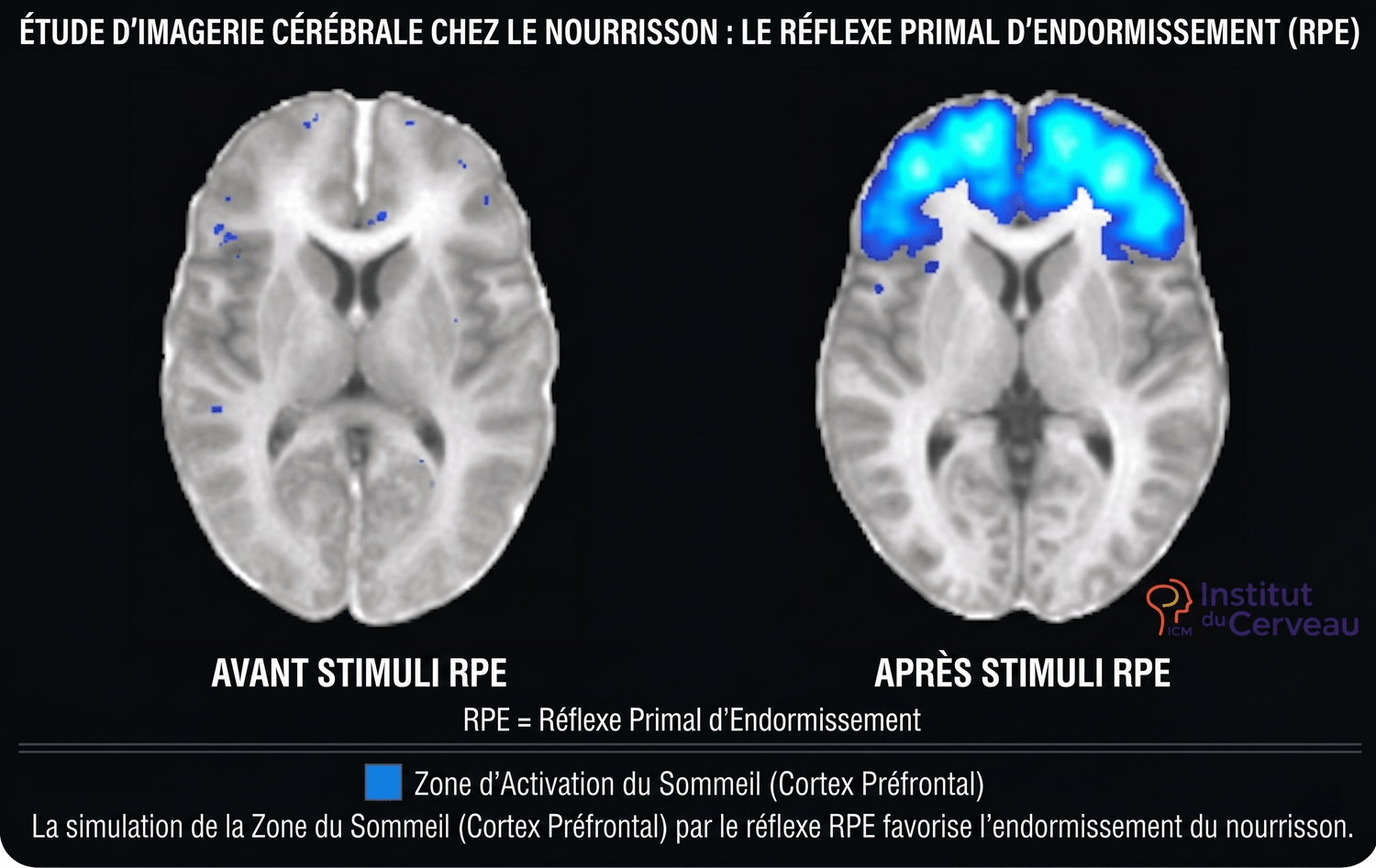 Cerveau du nourrisson — activation du Réflexe Primal d'Endormissement