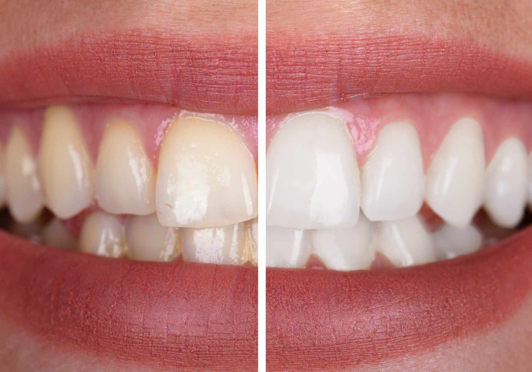 Teeth Whitening Before And After Unveiling Your Brightest Smile