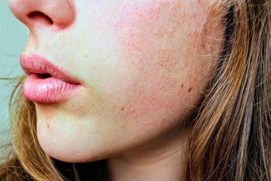 Visage d'une femme avec une peau atopique