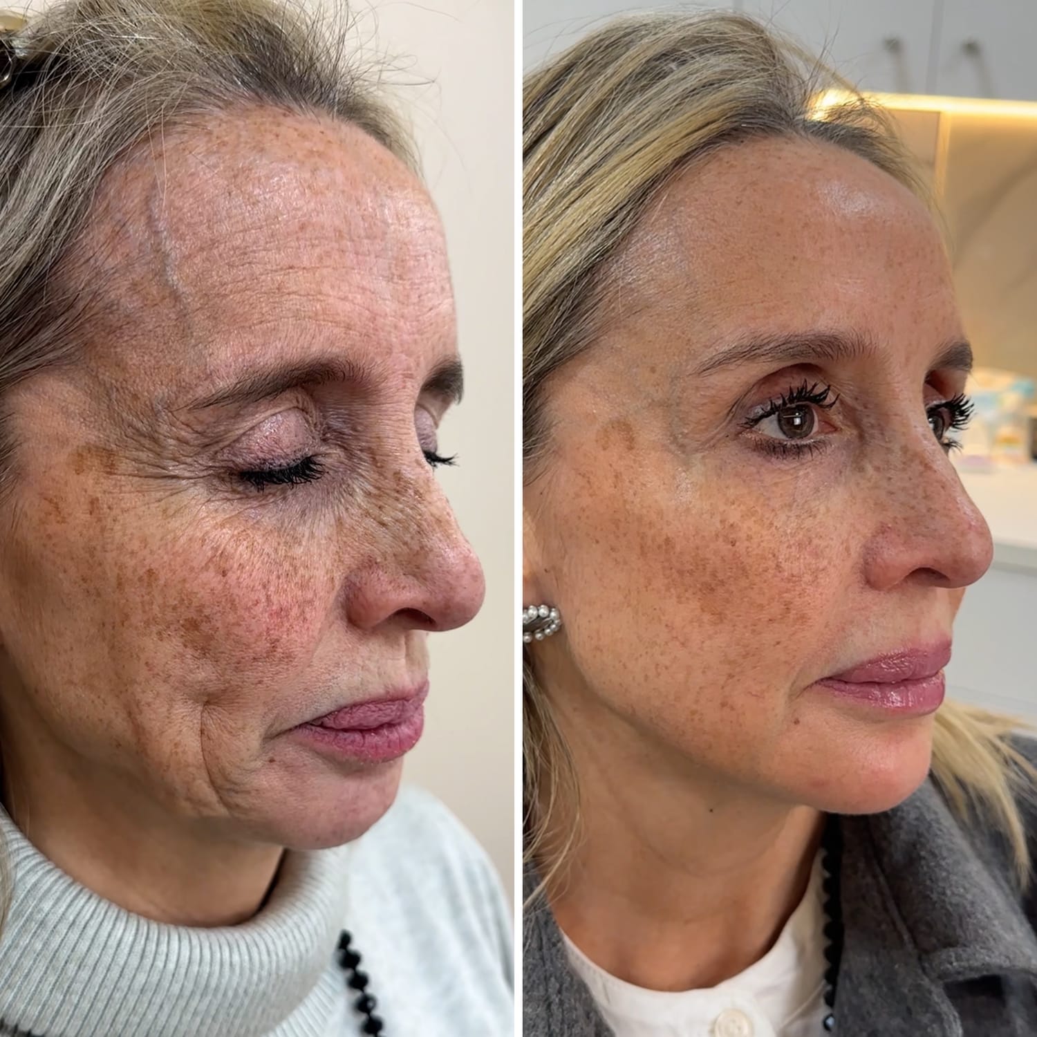 Resultado tratamiento Full Face