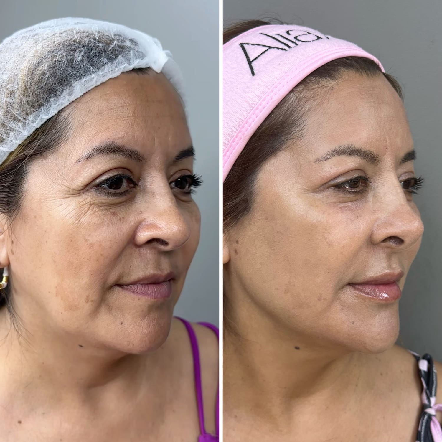 Resultado Full Face 1