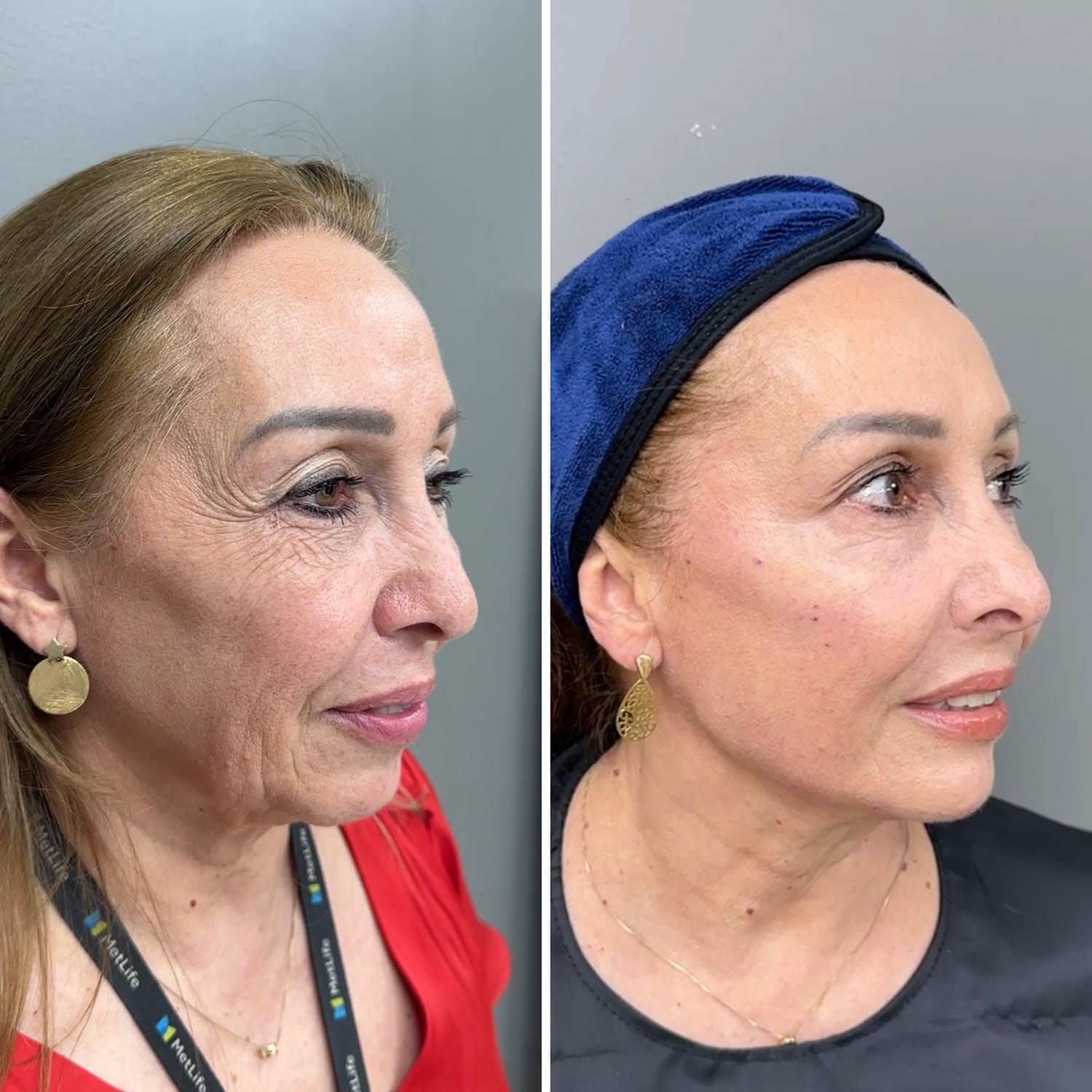 Resultado Full Face 2