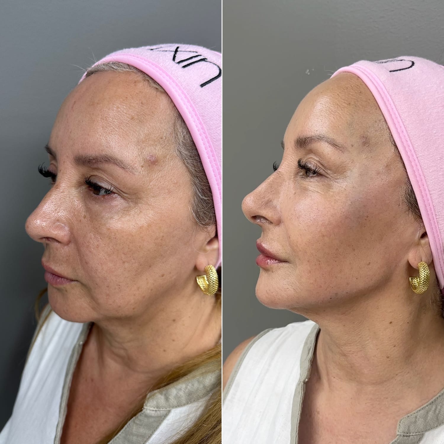 Resultado Full Face 3