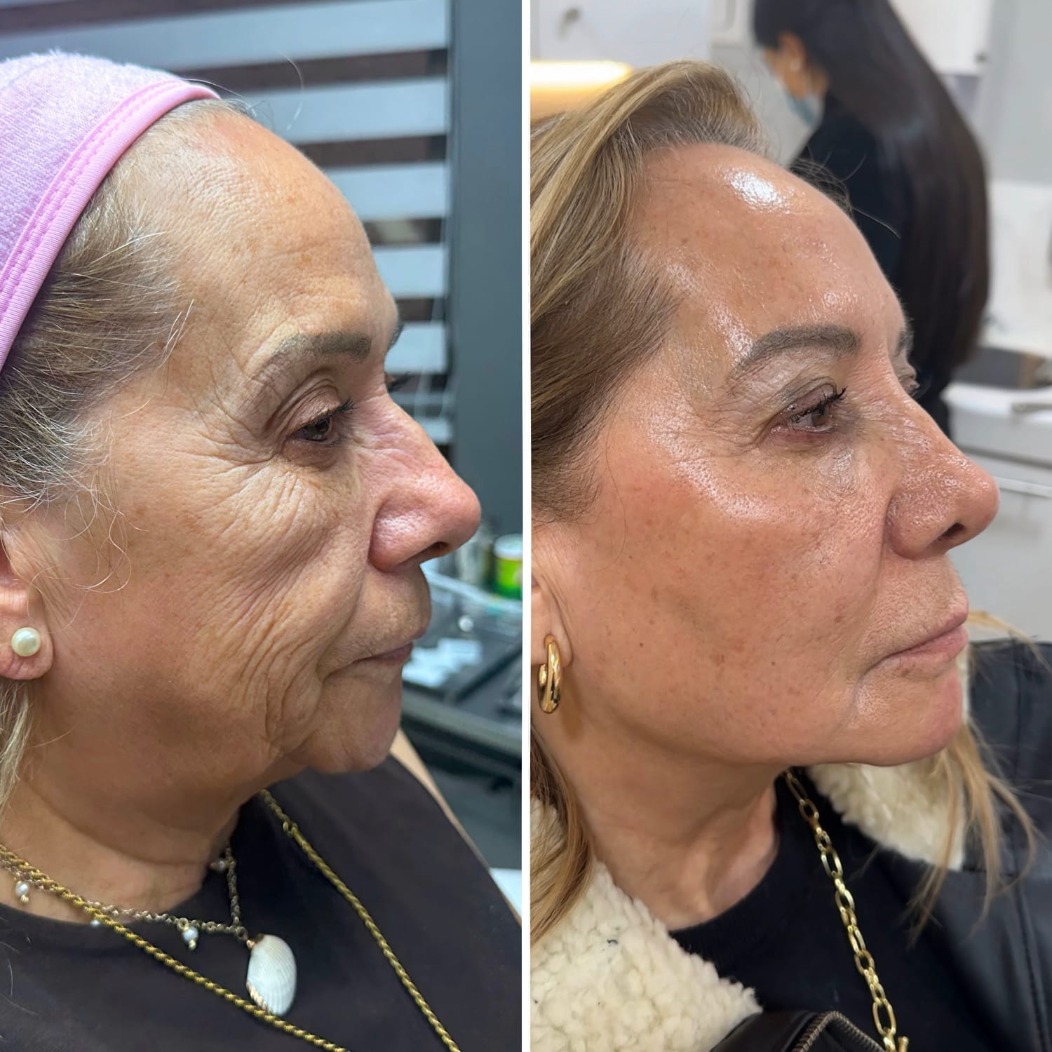 Resultado Full Face 4