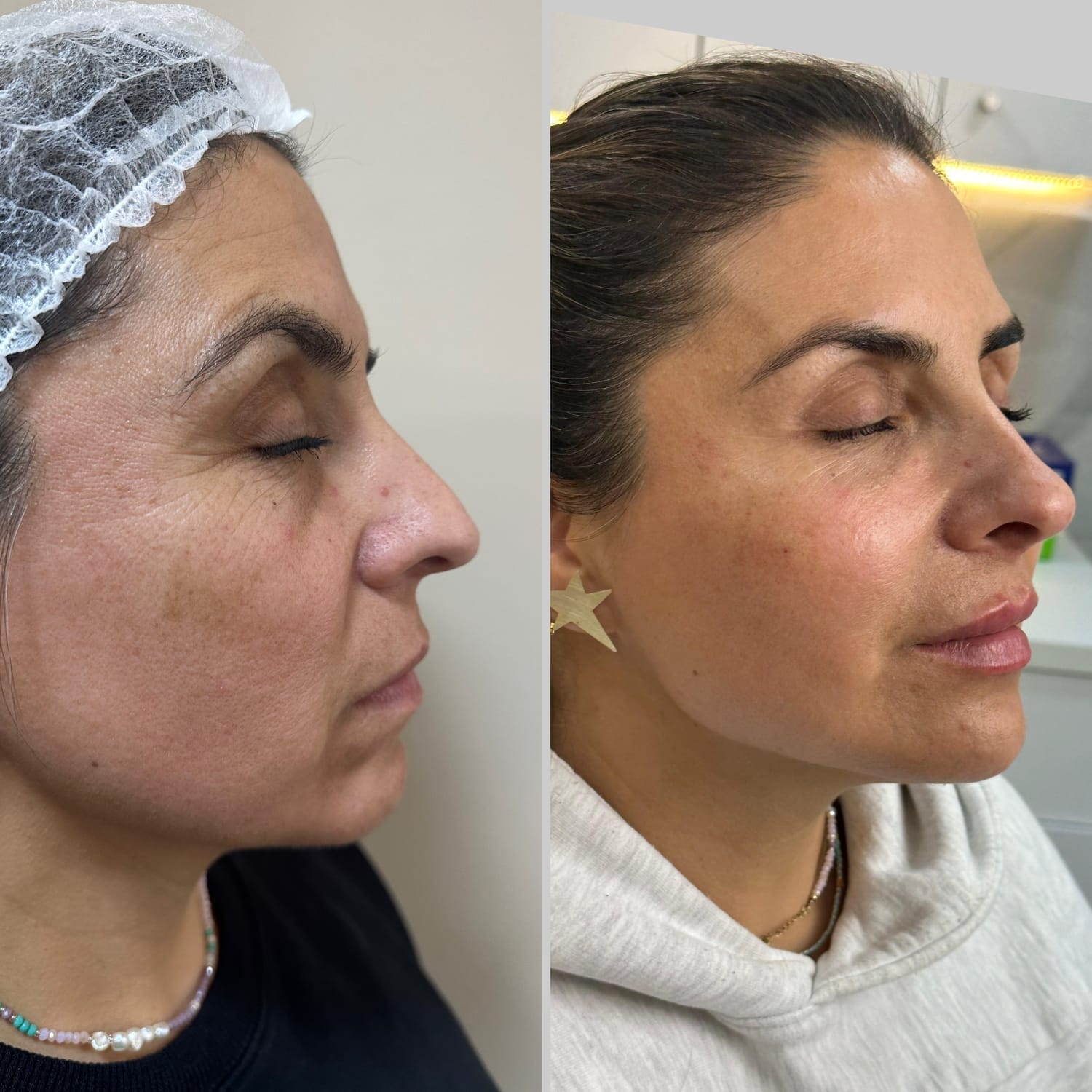 Resultado Full Face 5