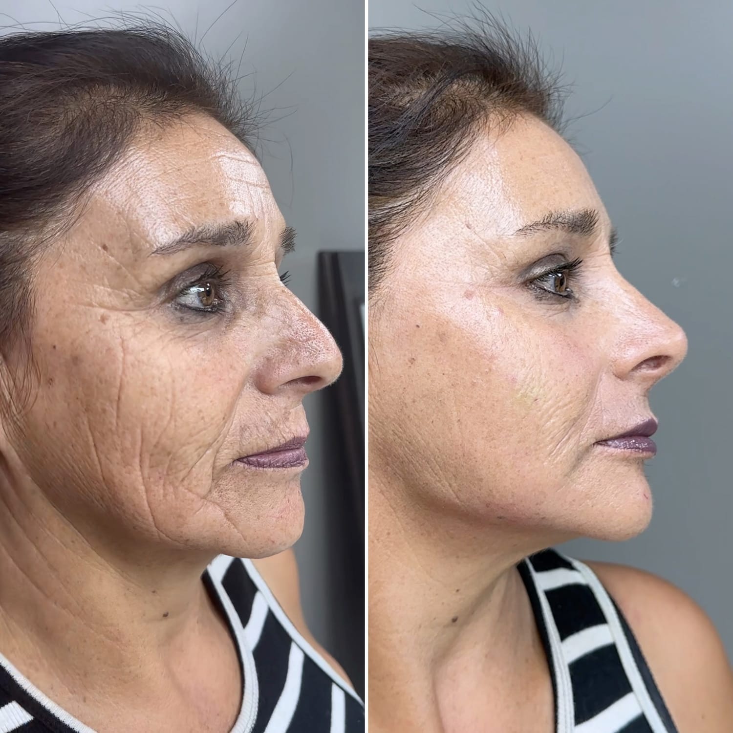 Resultado Full Face 6