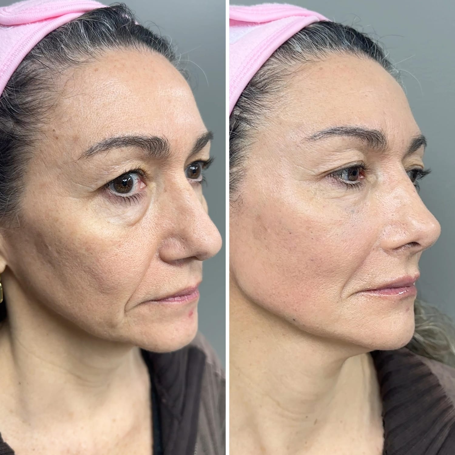 Resultado Full Face 7