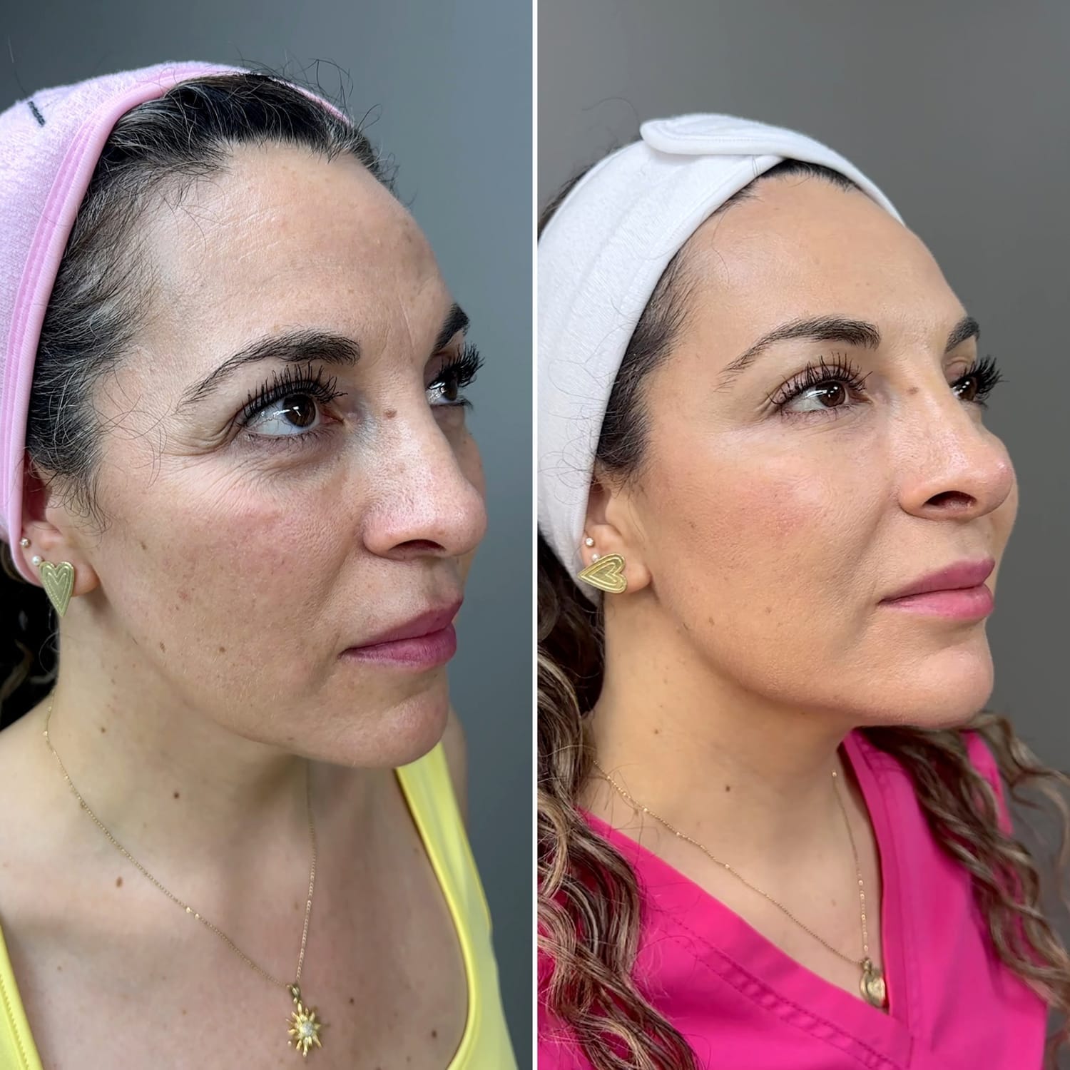 Resultado Full Face 8