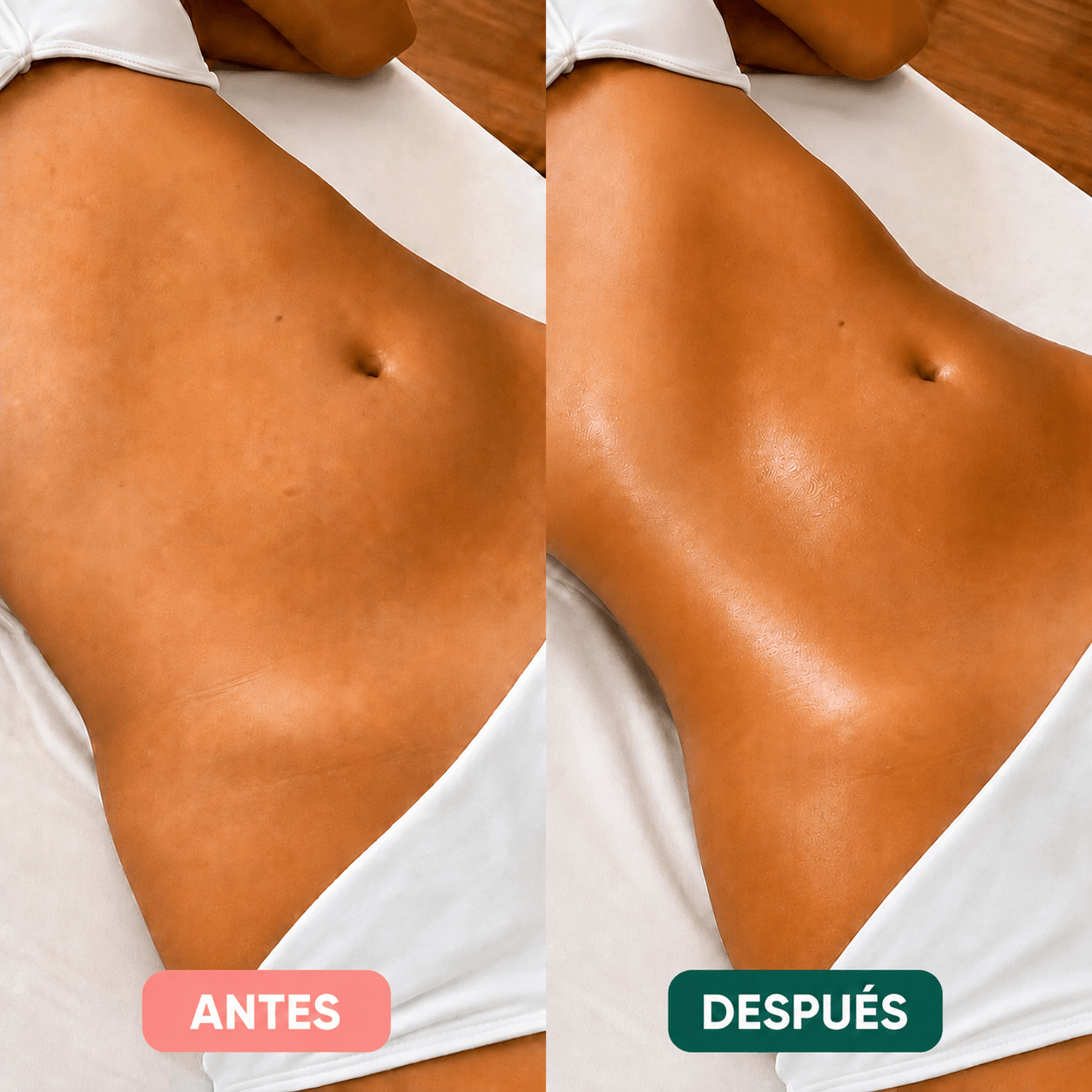Antes y después con lipodrenaje en abdomen