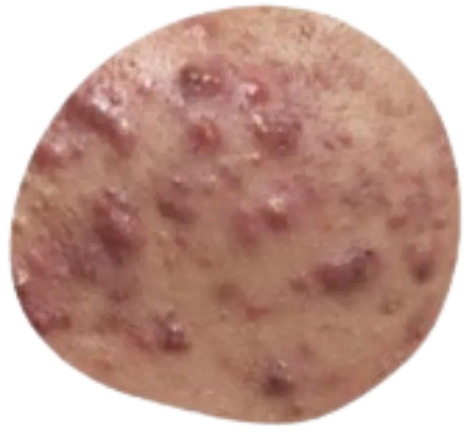 Acné inflamatorio