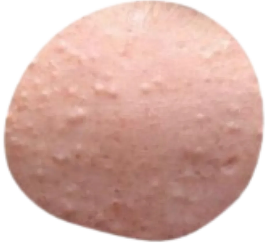Acné comedoniano leve