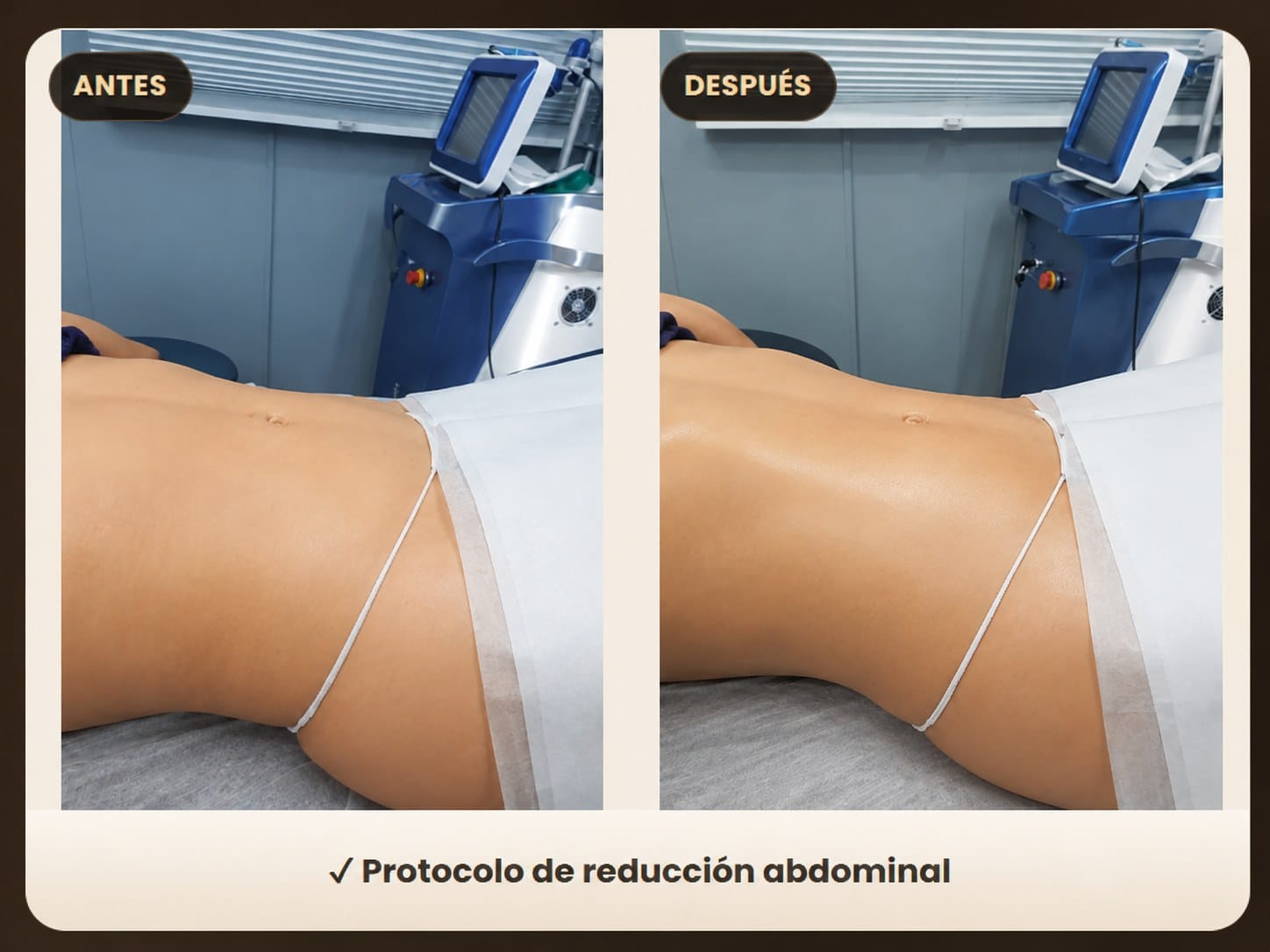 abdomen body contouring before after