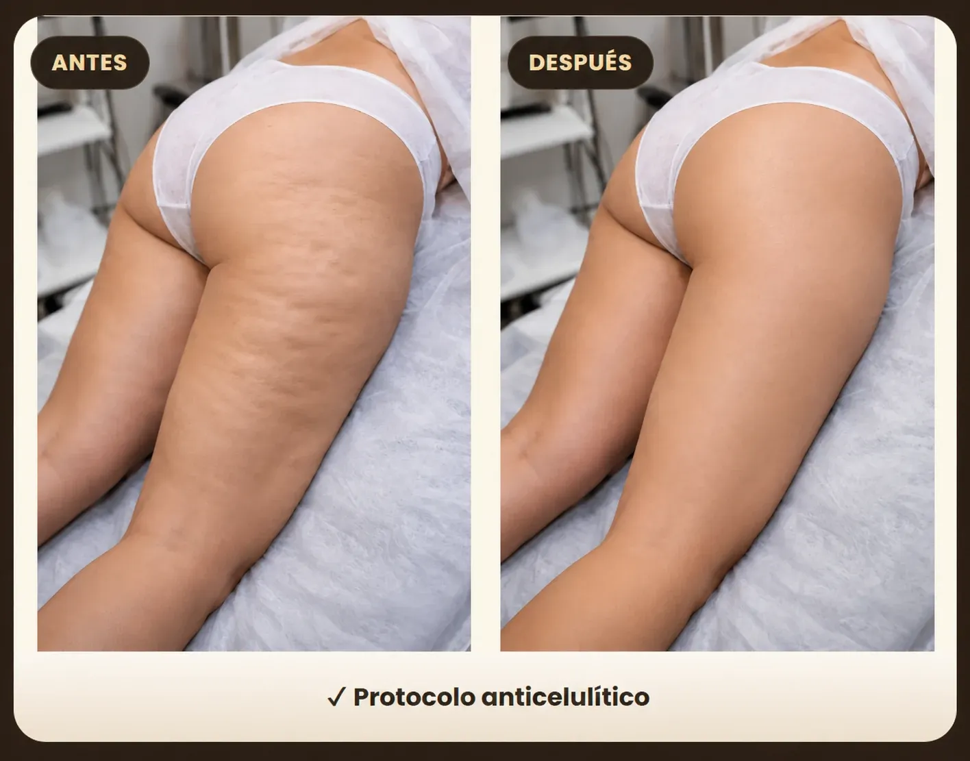 cellulite treatment before after thighs